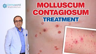 Molluscum Contagiosum Treatment  Dr Rohit Batra [upl. by Nelg91]