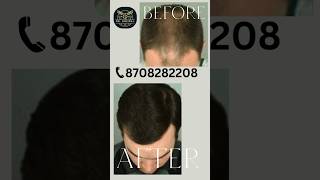 Hair Treatment Before amp After  Dr Grewal  8708282208 shorts viralvideo [upl. by Aicilas]