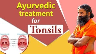 Ayurvedic Treatment for Tonsil  Swami Ramdev [upl. by Nordin144]