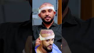 Hair Transplant Experience of Our Client from Hyderabad [upl. by Colp450]