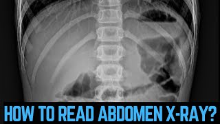 पेट का एक्सरे कैसे देखते हैं How to read abdomen xray petkaxraykaisehotahai abdominalxray xray [upl. by Gio720]