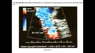 CARDIOLOGIE INSUFFISANCE AORTIQUE [upl. by Etoile]