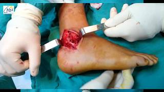 peroneal tendon dislocationluxation des tendons fibulairesCHU oujda [upl. by Essam]