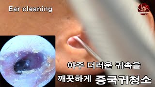 Ear cleaning 10년만에 받아보는 귀청소 지저분한 귓속 공개 [upl. by Alten]