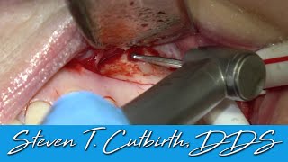 Maxillary 1st Molar Apicoectomy  Dental Minute with Steven T Cutbirth DDS [upl. by Jaan]