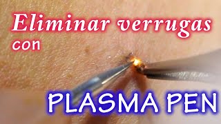 ELIMINANDO VERRUGAS CON PLASMA PEN [upl. by Oicapot]