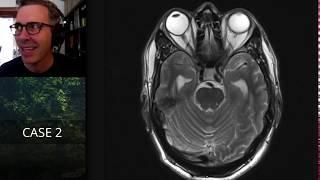 Isolation tutorial Neuroradiology with Frank Gaillard [upl. by Innej]