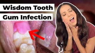 what does this SWOLLEN gum flap mean Pericoronitis Explained [upl. by Linkoski612]