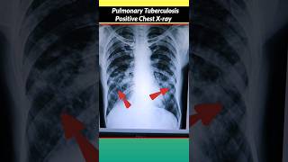 Normal vs TB Positive Chest xray shorts [upl. by Arimihc]