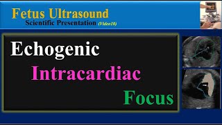 Fetus Ultrasound Echogenic Intracardiac Focus [upl. by Yank]