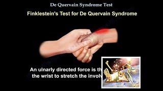 De Quervain Syndrome Test  Everything You Need To Know  Dr Nabil Ebraheim [upl. by Pump663]