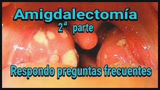 Mi operacion de amigdalas 2ª Parte Respondo a preguntas frecuentes [upl. by Chadabe318]