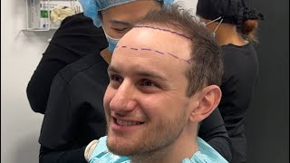 How to decide Hair transplant hairline height [upl. by Hankins]