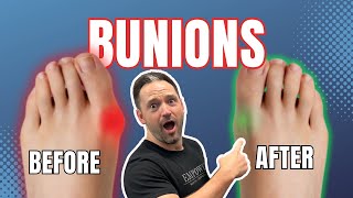 How To Fix Bunions  3 Easy Steps [upl. by Shing]