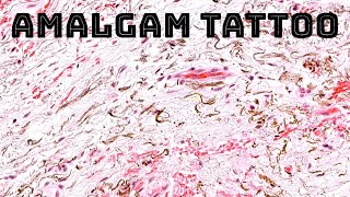 Amalgam quotTattooquot black spot in gumsgingiva from metal cavity filling dermpath oral pathology [upl. by Notnroht278]