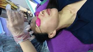 picosecond laser treatment [upl. by Reyotal]