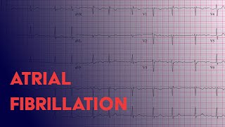 Atrial Fibrillation Afib  EKG ECG Interpretation [upl. by Valerio]