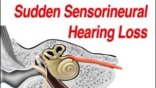 Sudden Sensorineural Hearing Loss Diagnosis Causes and Treatment [upl. by Alleroif]