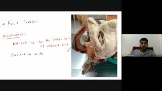 Head amp Neck Spotters  part  1  Dr Dhinesh Kumar  AIIMS [upl. by Annabelle]