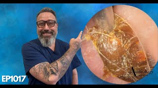 LONG EAR WAX PLUGS DEEP EAR WAX REMOVAL AND SKIN REMOVAL  EP1017 [upl. by Ygiaf]