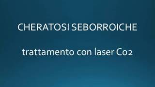 Trattamento con Laser Co2 Cheratosi seborroiche  Dr Andrea Platamone [upl. by Rramel]