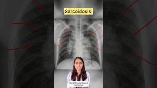 Sarcoidosis xray xrayclasses chest lungs pulmonologist sarcoidosis pulmonary radiology [upl. by Enelcaj]