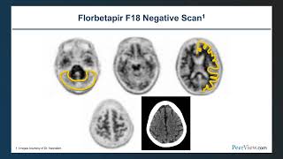 Applying Nuclear Medicing to Quantify Neuropathology and Facilitate Diagnosis in Alzheimers Disease [upl. by Ylaek]