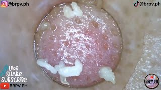 PORE VACUUM BLACKHEAD REMOVAL DEMO FOR Week32 CLASSICAL MUSIC brpvph​satisfying [upl. by Sug618]