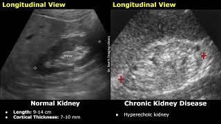 Kidney Ultrasound Normal Vs Chronic Kidney Disease CKD Imaging Findings  Chronic Renal Failure [upl. by Dloreh]