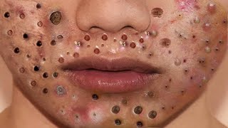 Big Cystic Acne Blackheads Extraction Blackheads amp Milia Whiteheads Removal Pimple Popping  5352 [upl. by Aharon965]