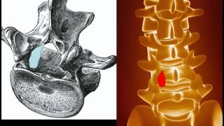 Behandlung der Spinalkanalstenose [upl. by Regnig]