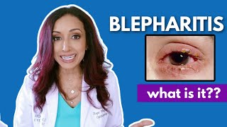 What Is Blepharitis Eye Doctor Explains [upl. by Morgen]