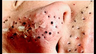 Blackhead The important cleansing skin Blackhead extraction [upl. by Uella942]