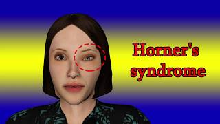 Horners syndrome  Symptoms and causes [upl. by Kirbie782]