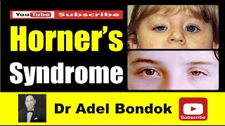 Horners Syndrome Dr Adel Bondok Making Anatomy Easy [upl. by Maltz]