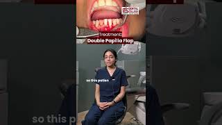 Case Of The Week  Root Coverage by Double Papilla Flap Procedure  ITS Dental Colege [upl. by Ivette]