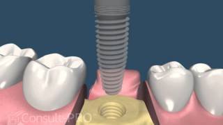 ConsultPRO Single Implant [upl. by Lupita]