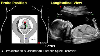 Obstetric Ultrasound Probe Positioning  Pregnant Uterus amp Fetus Transducer Placement USG Scan [upl. by Aihseket]