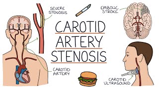 Understanding Carotid Artery Stenosis [upl. by Morrell]