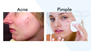 Difference Between Acne And Pimple Best Skin Care Clinic In Bangalore  Manipal Hospitals [upl. by Macario]