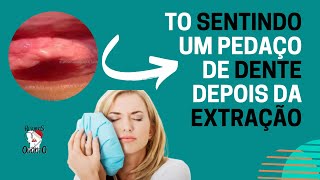 DENTISTA DEIXOU PEDAÇO DE DENTE DEPOIS DA CIRURGIA  ESPÍCULA ÓSSEA [upl. by Hokanson]