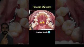 Crooked teeth braces process braces orthodontist dentist dentistry crookedteeth [upl. by Kristianson]