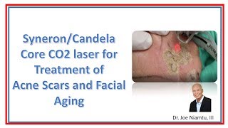 The SyneronCandela Core CO2 Laser Treatment for Acne Scars and Facial Aging [upl. by Heuser]