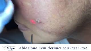 Rimozione nevi dermici con Laser Co2 [upl. by Marta]