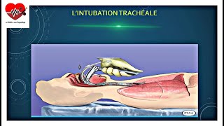 lintubation TRACHÉALE  programmé [upl. by Bradley]