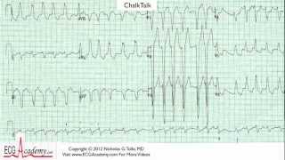 ECG Interpretation Tutorial  ChalkTalk 26 Advanced Level [upl. by Ahsoym]