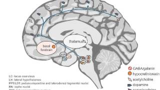 Neuropathology and Treatment of Hypersomnia [upl. by Intisar114]