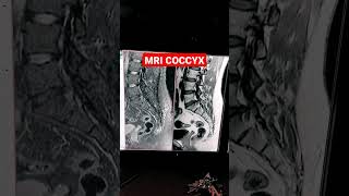 MRI of Coccyx  Post Traumatic Fracture mri shorts mriradiographer MRI L S Spine with Coccyx [upl. by Aileve]