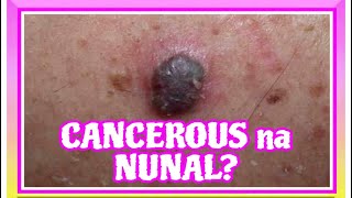 CANCEROUS na Nunal Alaman ang mga itsura mole medical cancer facts treatment [upl. by Strawn170]