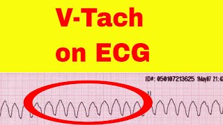 Ventricular Tachycardia on ECG [upl. by Perlman]